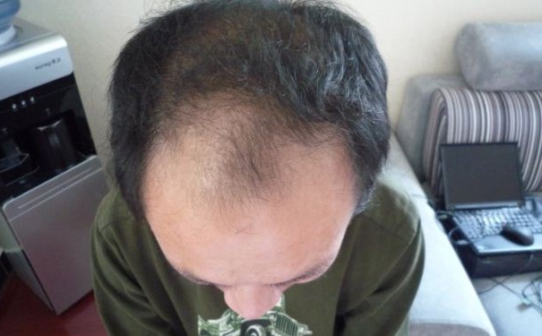 什么原因会导致男性秃顶？哪些习惯可以防止男人秃顶？(1)