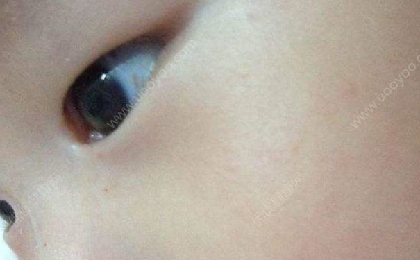 小孩眼睛红血丝是怎么回事？宝宝眼睛有血丝爱揉眼怎么办？(1)