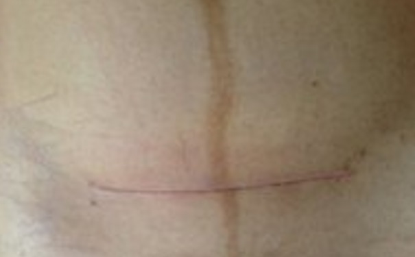 剖腹产睡觉应该怎么躺着？剖腹产后怎么加快伤口愈合速度？(1)