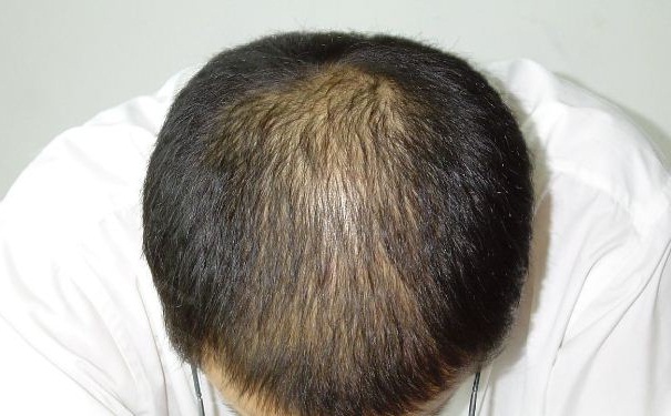 男人脱发原因有哪些?预防男性秃顶要怎么做？(1)