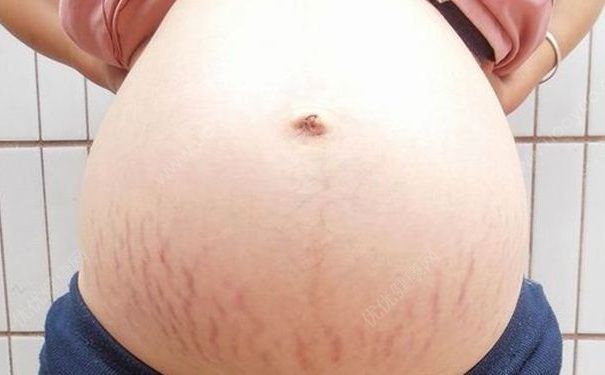 妊娠纹到底是怎么形成的？消除妊娠纹的食谱有哪些？(1)