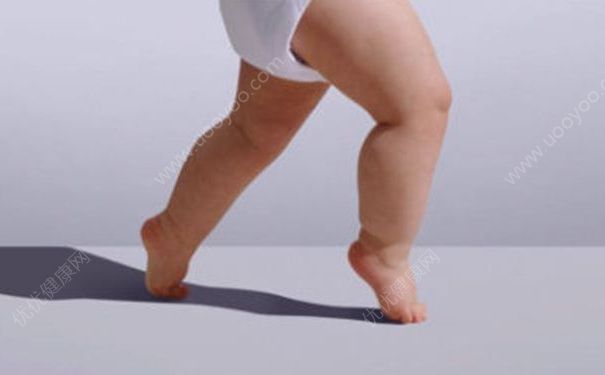 幼儿八字脚的原因有哪些？预防幼儿八字脚要注意什么？(1)