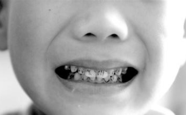 小孩子如何长一口好牙？孩子怎么长好牙？(1)