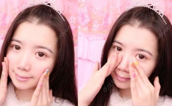 光子嫩肤有后遗症吗？光子嫩肤到底有没有副作用？[图]