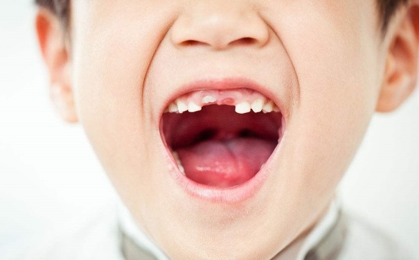 孩子牙掉了怎么处理？孩子换牙期怎么护理？(1)