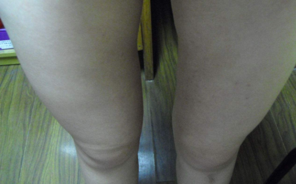 小腿如何去水肿？去水肿有何方法？(1)