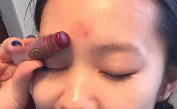 中医快速祛痘的方法有哪些？中医如何快速祛痘？(1)