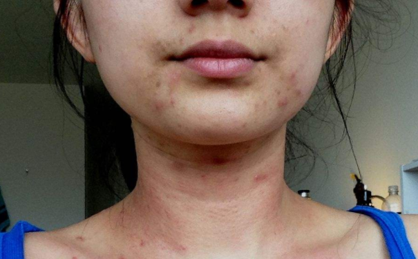 减少痘痘的产生要注意什么地方？如何减少痘痘的产生？(1)