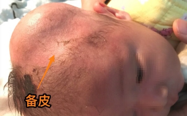 婴儿脑血肿有后遗症吗？婴儿脑血肿该怎么办？(1)