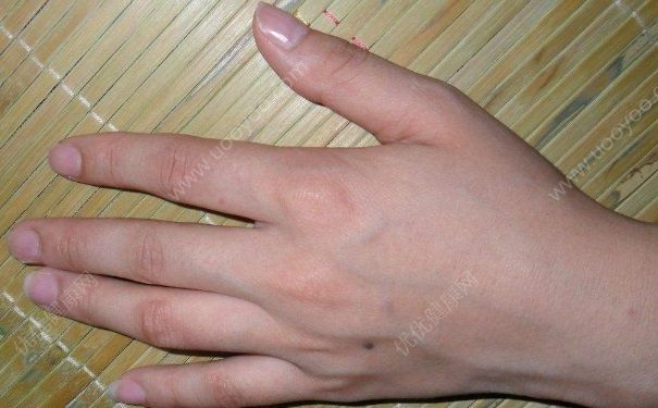冻疮为什么会复发呢？冻疮到底该怎么治疗好？(2)