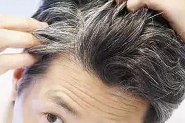 青少年为什么会有白发？少年白是怎么回事？(3)
