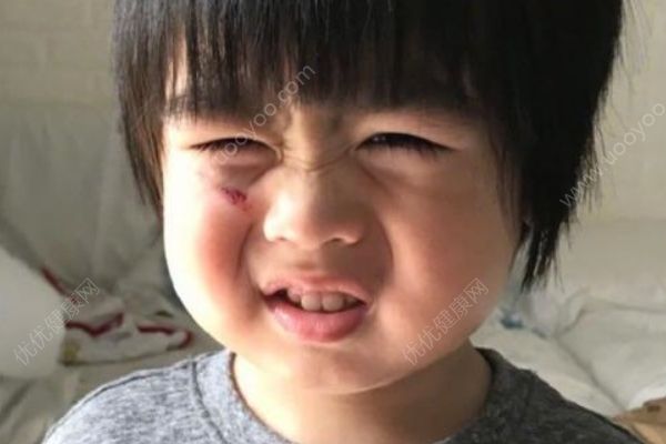 林志颖儿子跌伤脸，跌伤后如何处理？(2)