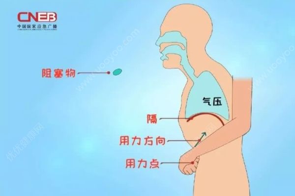 亲戚喂了一粒花生导致婴儿肺气肿，应急急救方法须知道！(3)