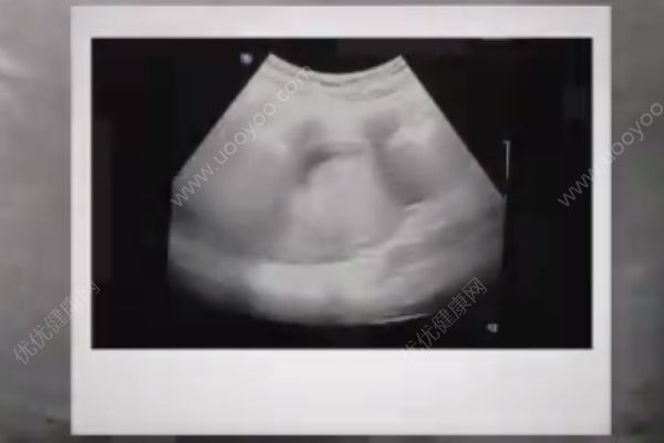 孙燕姿晒二胎宝宝B超视频做新歌预告，怀二胎要注意什么？(4)