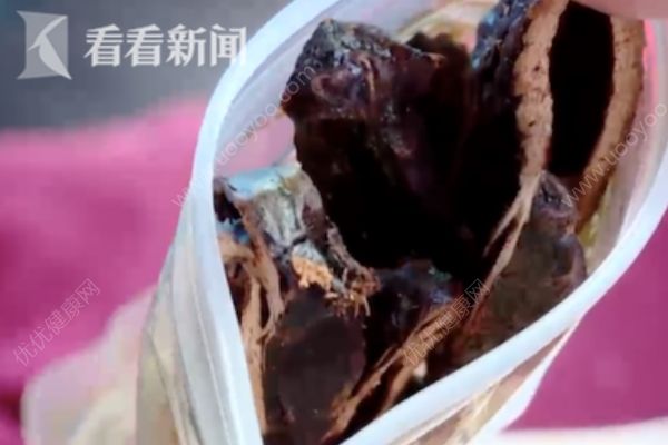 男子每天吃5包槟榔连吃10年患癌，长期吃槟榔小心口腔癌！(2)